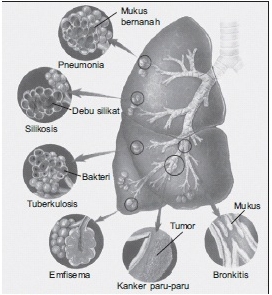 ciri ciri orang terkena penyakit paru-paru